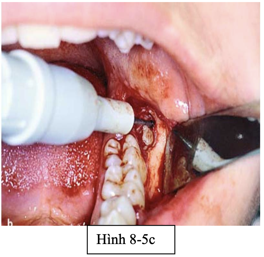 Tiểu phẫu R8 nghiêng gần